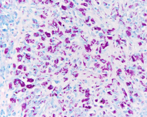 Acid Fast Bacilli - Zeihl Nielsen